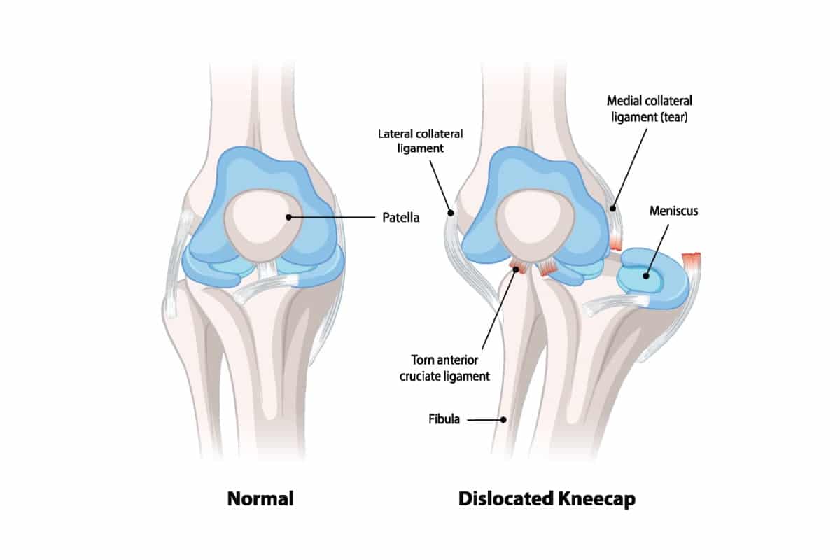 kneecap patella dislocation