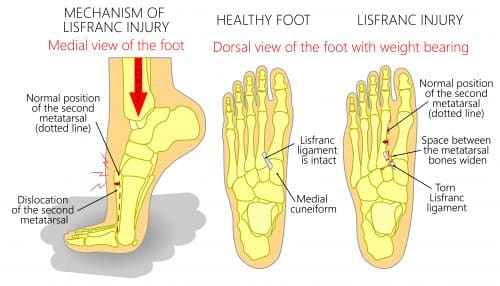lisfranc Injury