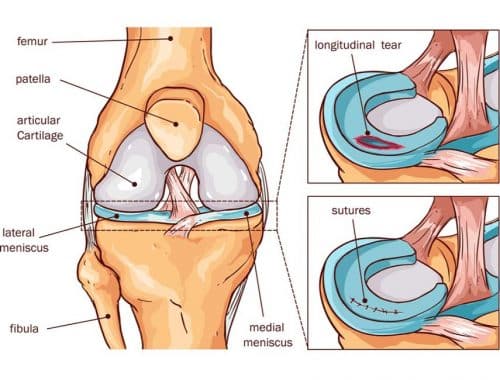 meniscus tear surgery cost singapore