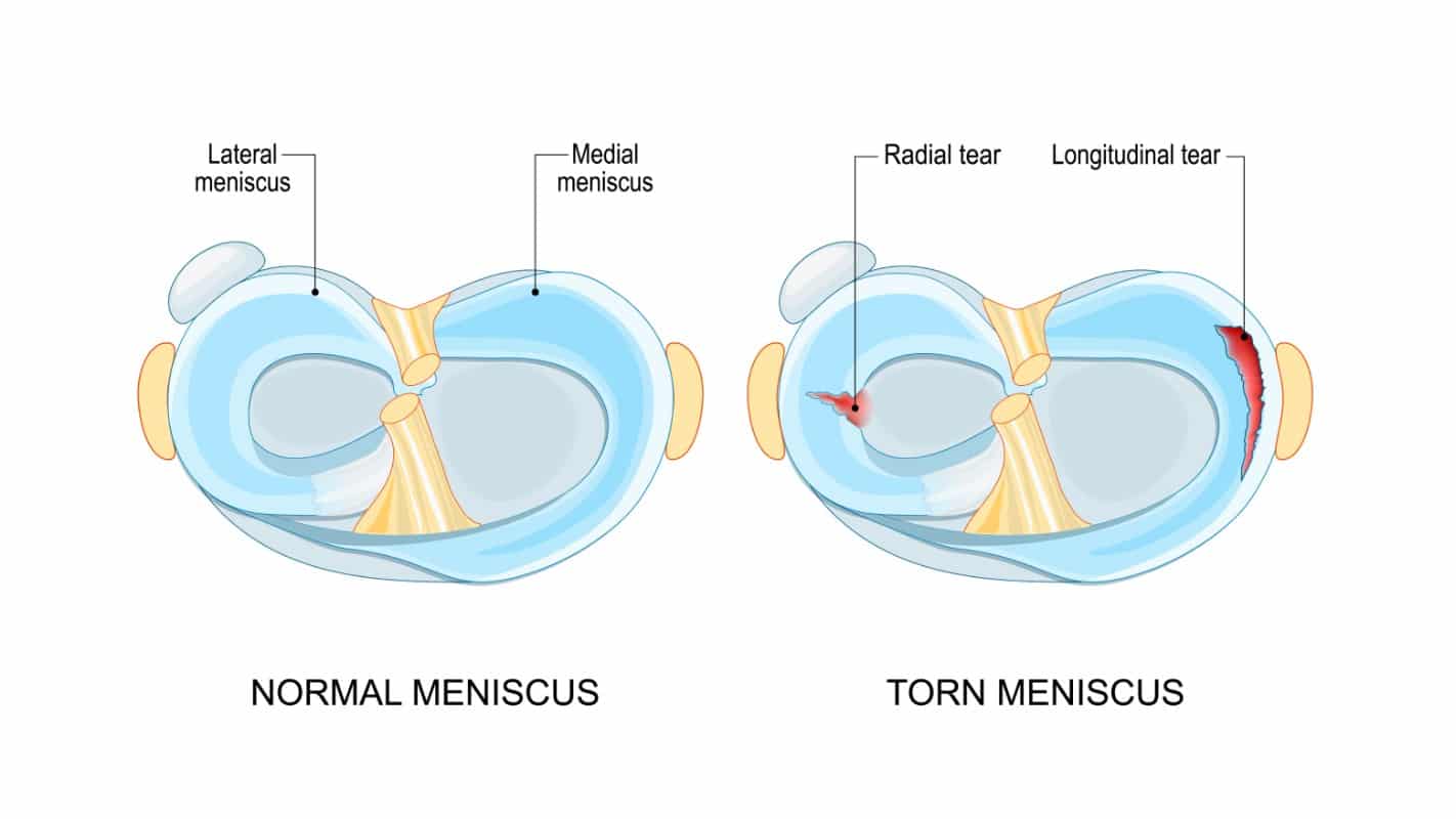 meniscus tear surgery singapore