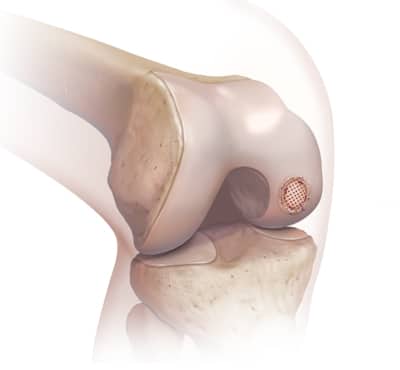 microfracture of osteochondral lesion