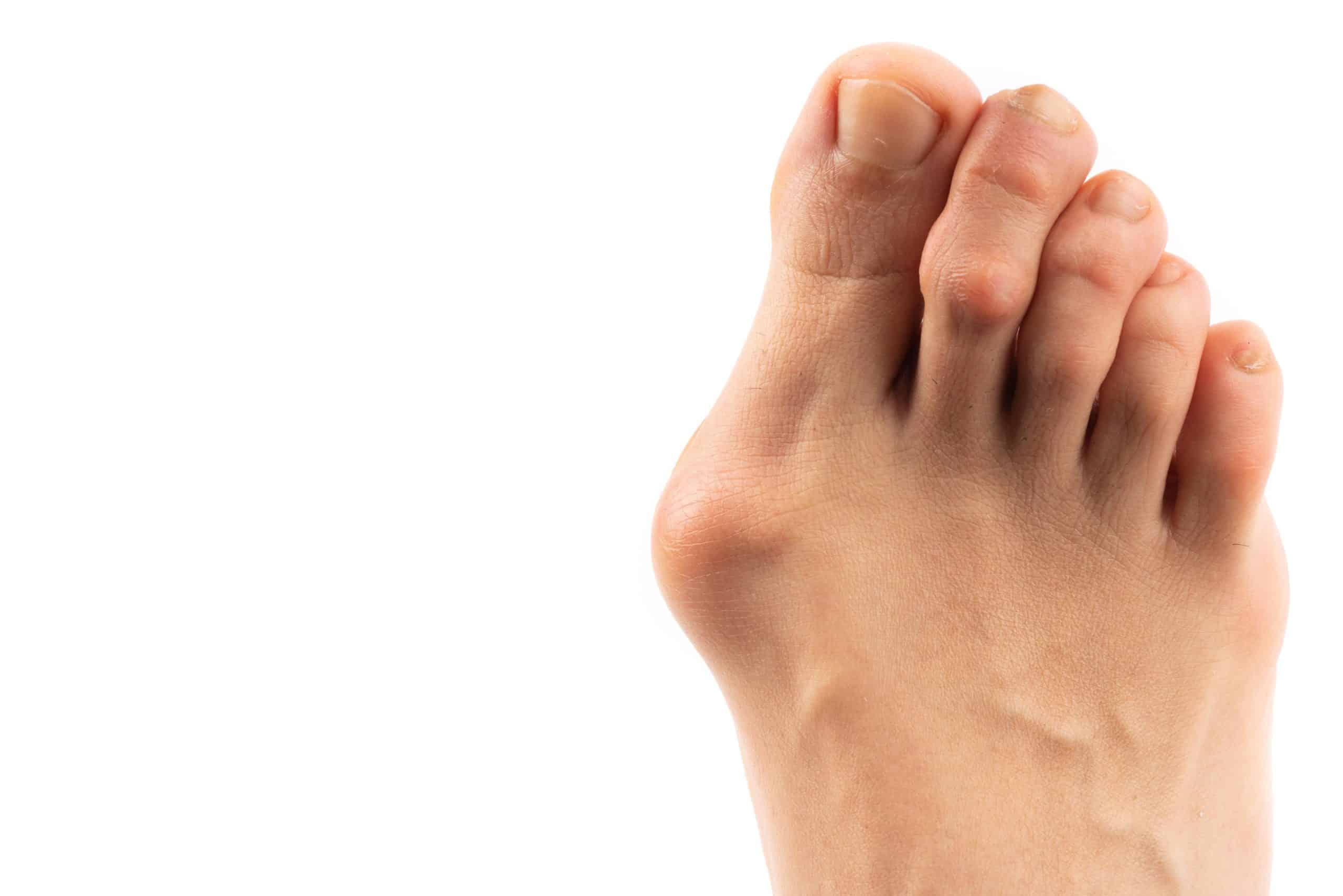 minimally invasive bunion surgery