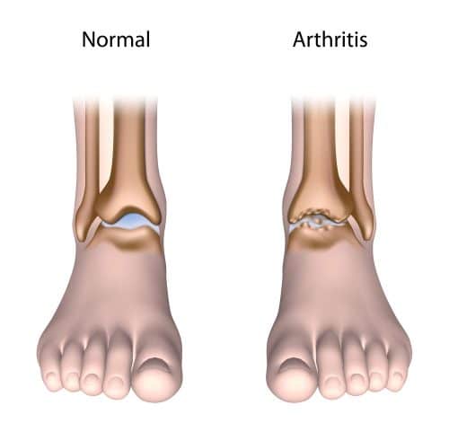 normal ankle vs ankle with arthritis diagram