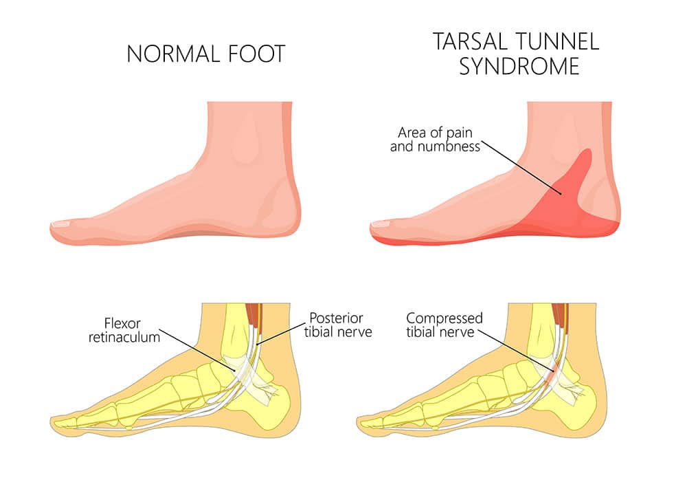 normal foot vs tarsal tunnel syndrome