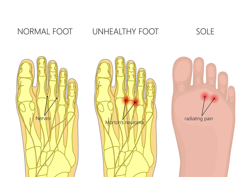 normal vs unhealthy foot