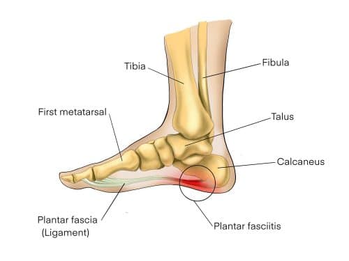 plantar fasciitis causes