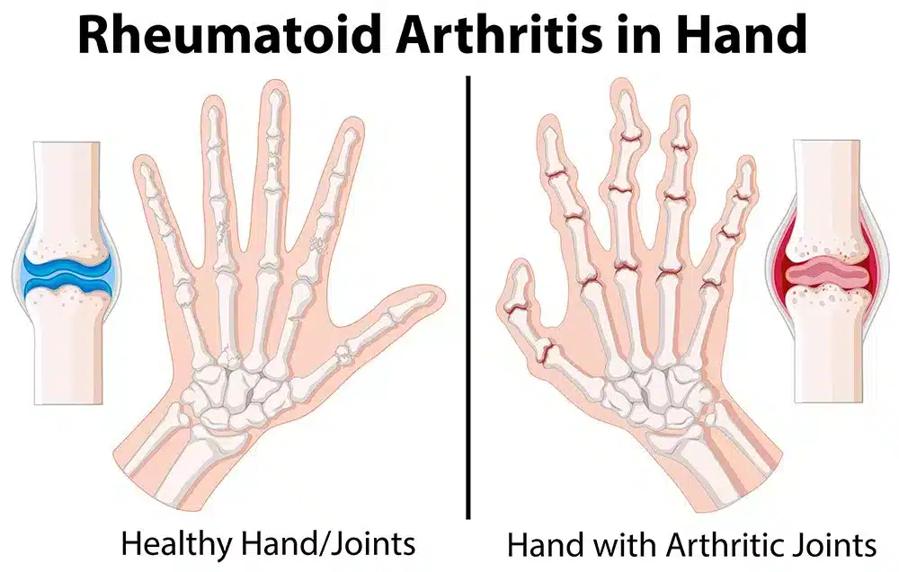 rheumatoid arthritis in hands