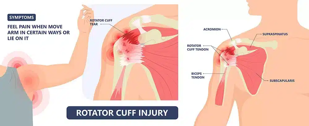 rotator cuff injury