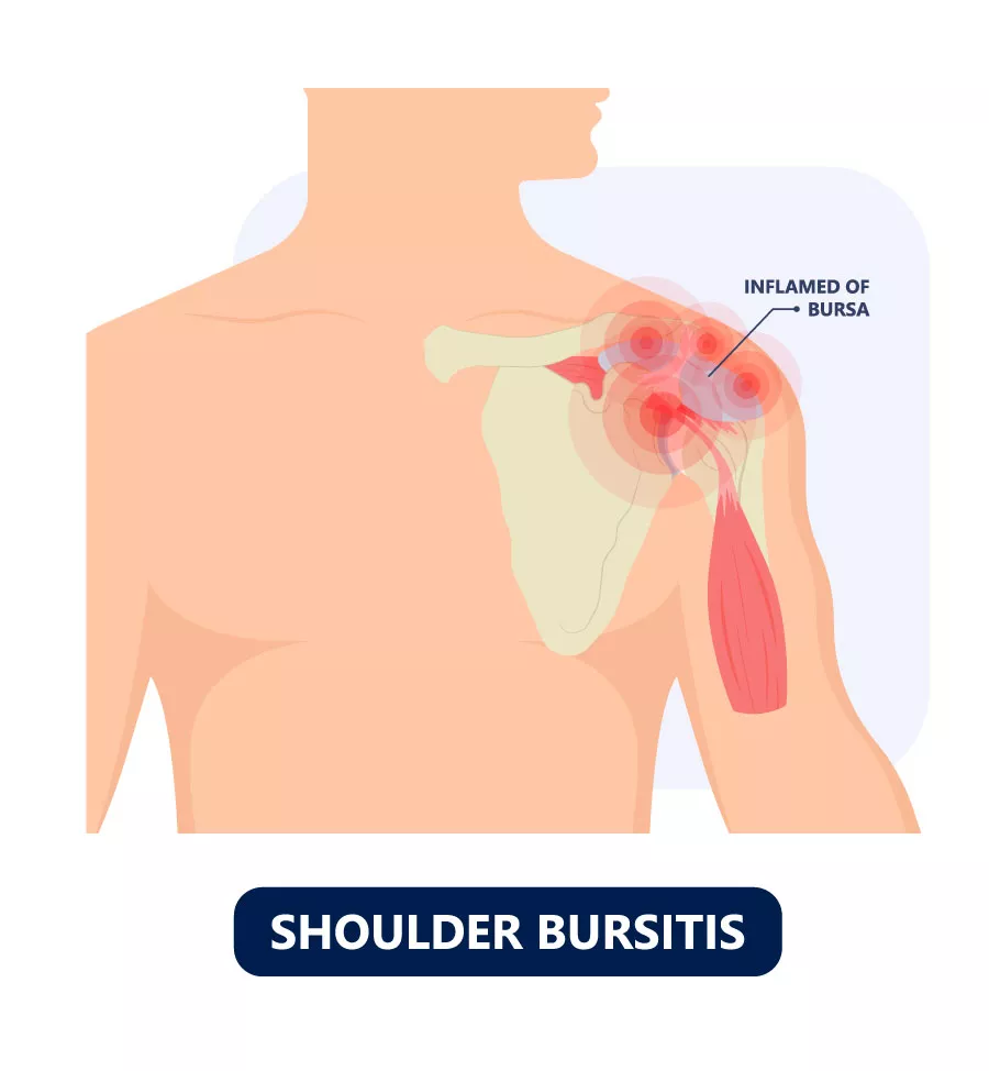 shoulder burisitis