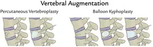 spine fractures orthopaedic specialist singapore