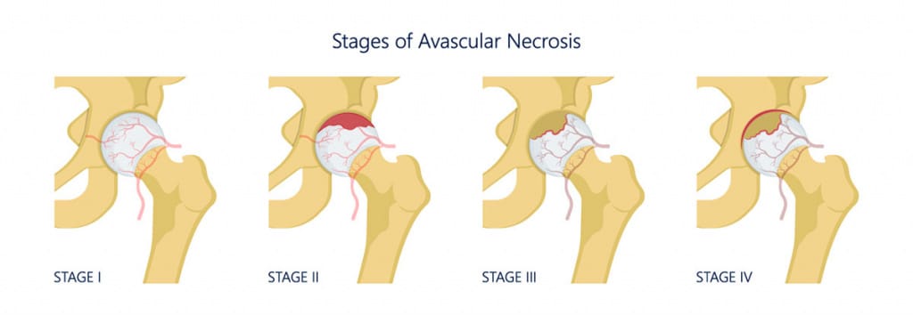 stages of avascular necrosis