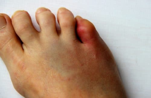 toe fracture