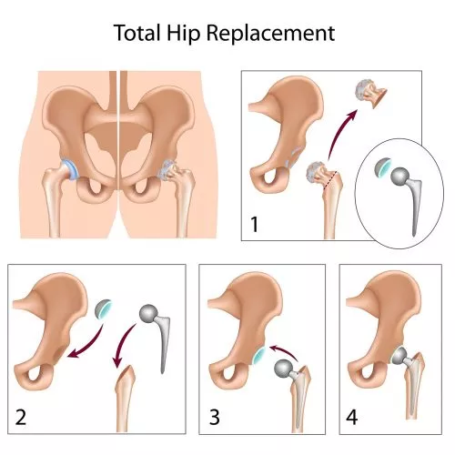 total hip replacement hip arthroscopy surgery singapore