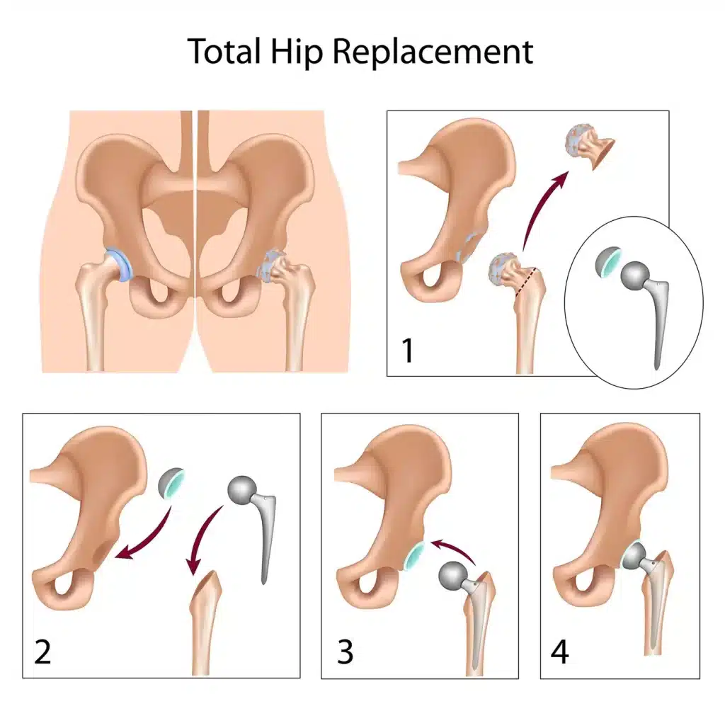 total hip replacement procedure diagram