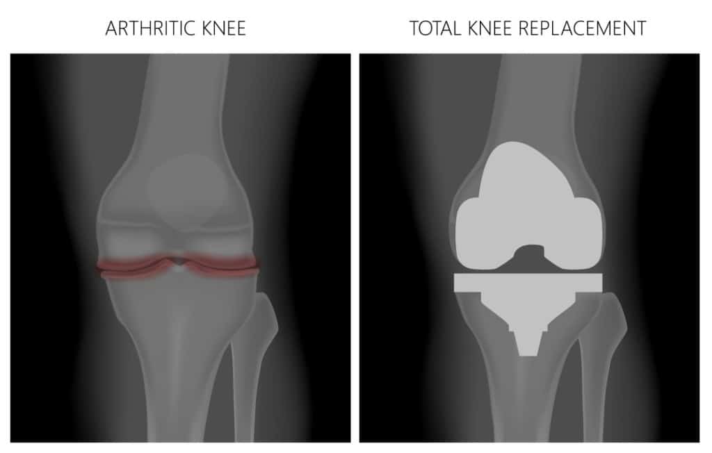 total knee replacements knee specialist singapore